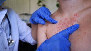 Още 7 случая на морбили у нас: болниците във Враца и Плевен са почти запълнени