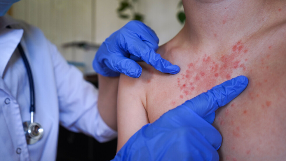 Още 7 случая на морбили у нас: болниците във Враца и Плевен са почти запълнени